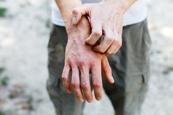 6 remèdes maison pour traiter la dermatite de contact