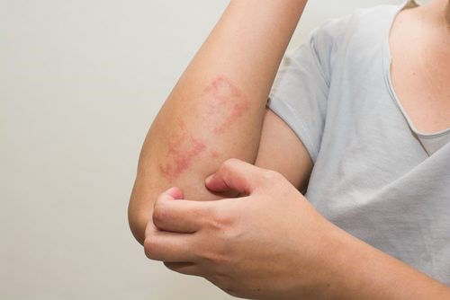 éviter les poussées de psoriasis