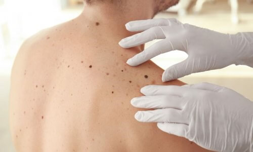 test ABCDE cancer de la peau
