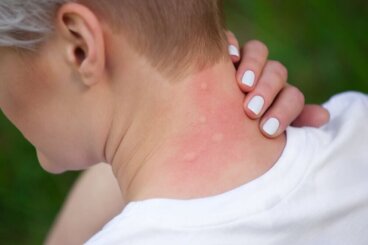 Le Fenistil contre les piqûres, les brûlures et l'urticaire