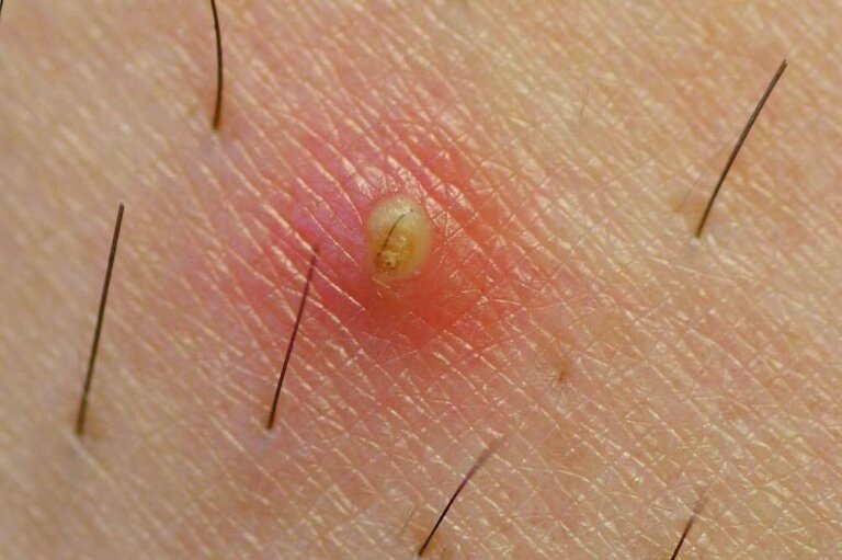 Comment prévenir les poils incarnés