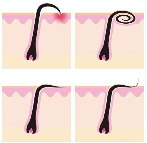 combattre les poils incarnés