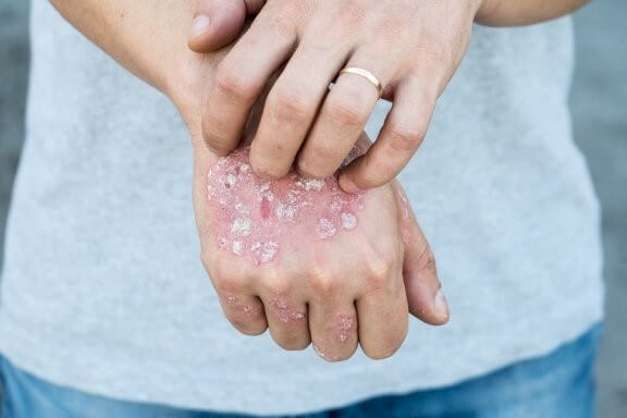 5 traitements topiques à base de plantes contre le psoriasis
