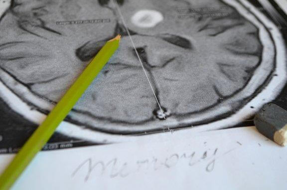 Amnésie : causes, symptômes et prévention