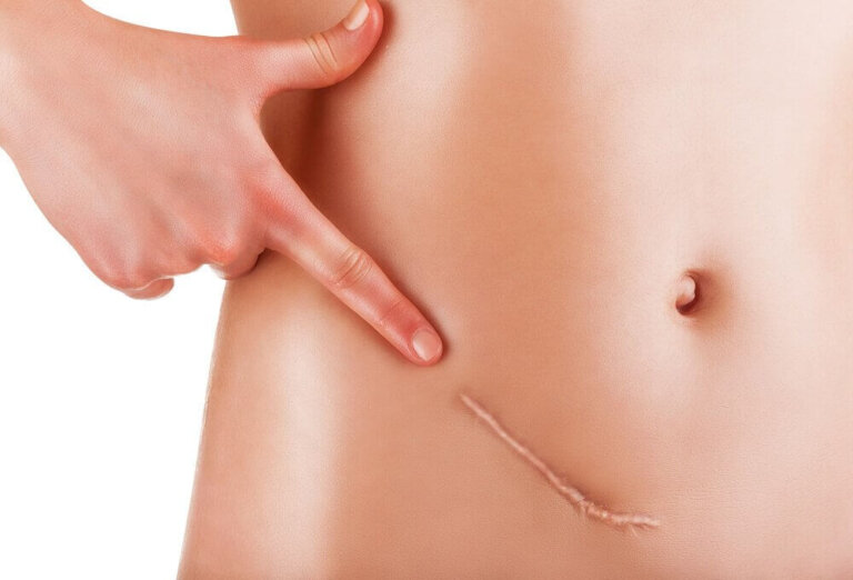 Quelques conseils pour se remettre de l'appendicite