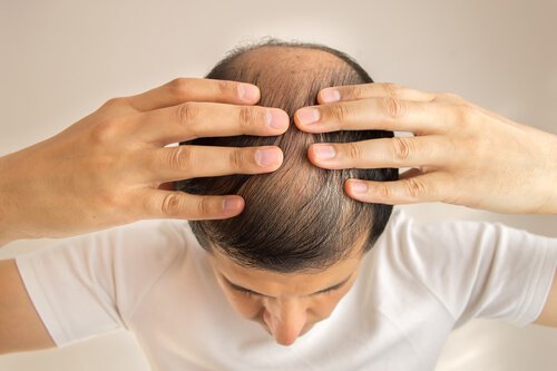 Les causes de la chute de cheveux
