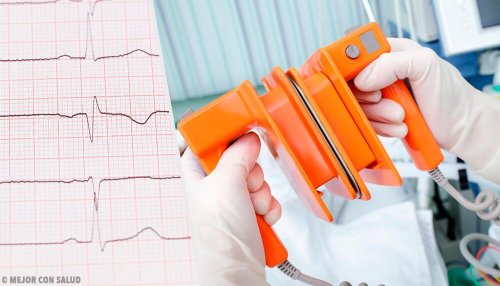 électrocardiogramme pour analyser la réponse cardiaque et la fibrillation auriculaire