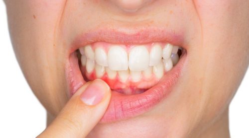 Qu'est-ce qu'un abcès dentaire et comment faut-il le traiter ?
