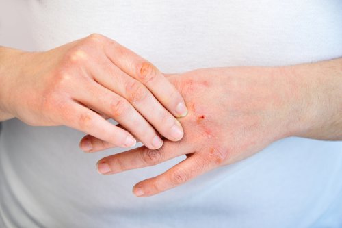 Mains gercées : 10 recommandations pour en prendre soin