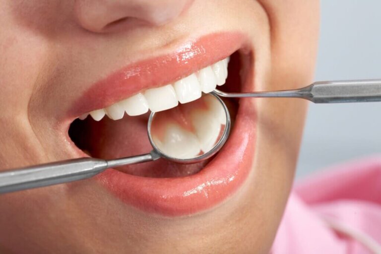 5 remèdes naturels pour lutter contre les caries dentaires