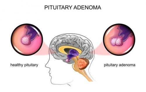 Tumeur de la glande pituitaire (ou hypophyse) : causes et symptômes