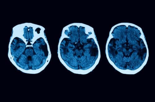 Atrophie corticale postérieure : diagnostic et traitement