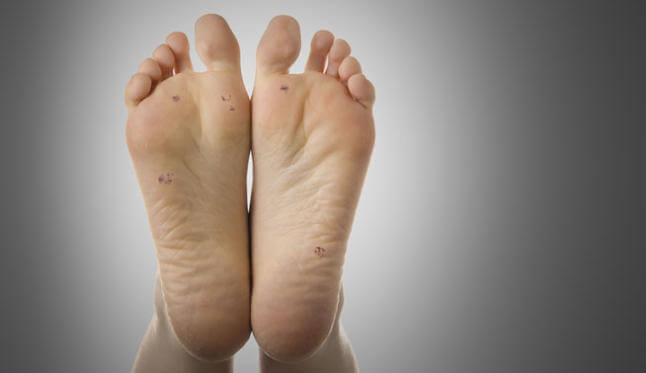 comment traiter une verrue plantaire ?