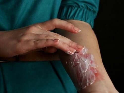 Traiter une brûlure de la peau