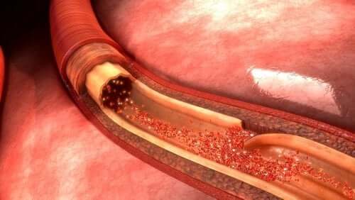 Qu'est-ce qu'une dissection aortique ?