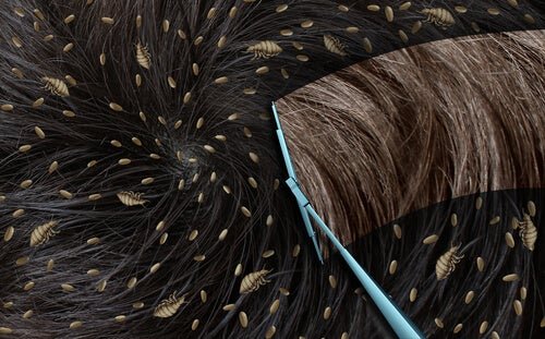 Des poux et des lentes sur un cuir chevelu