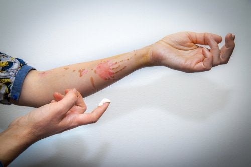 Les premiers secours pour soigner une brûlure superficielle