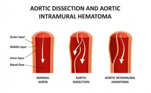 schéma de la dissection aortique