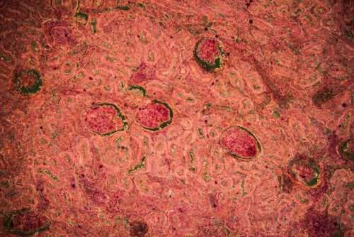 Tuberculose rénale : diagnostic et traitement