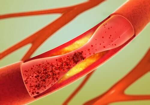 Un vaisseau sanguin endommagé dans le cadre de la démence vasculaire