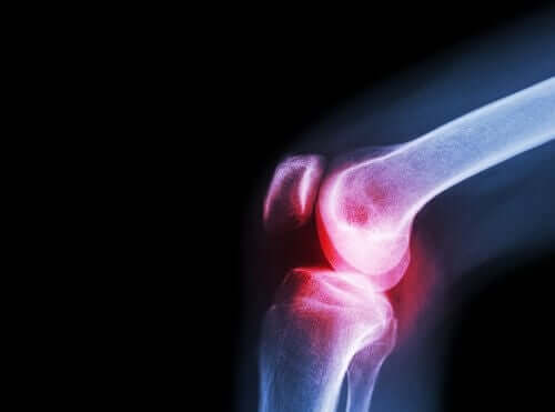 Une radiographie de l'arthrose au genou