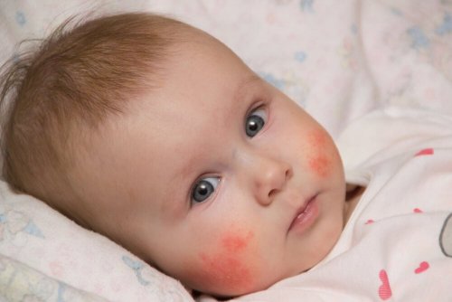 Un bébé avec une dermatite atopique sur les joues