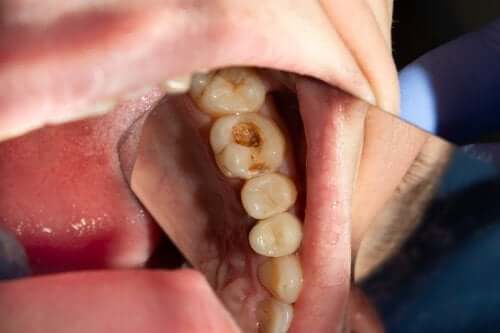Comment se forment les caries dentaires ?