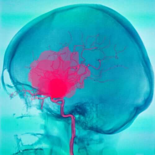 L'imagerie d'une paralysie cérébrale due à une hémorragie