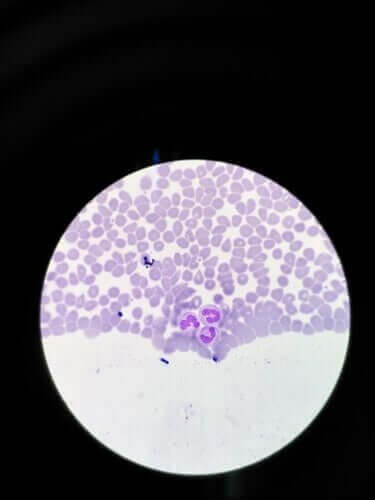 Neutropénie : symptômes et traitements