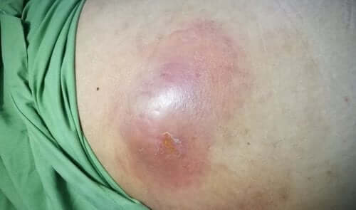 Abcès intra-abdominal : causes, symptômes et traitement