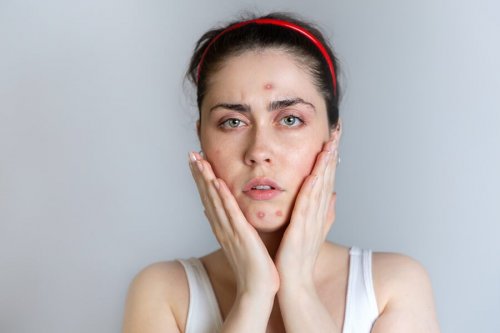 Une femme qui souffre d'acné pendant les règles