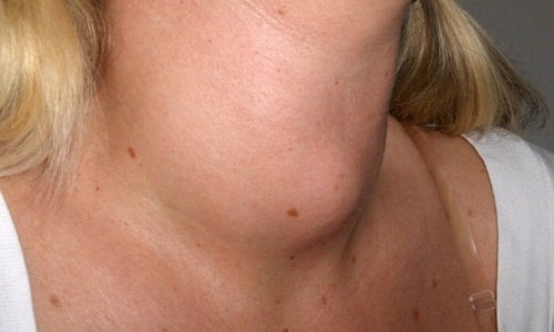 Une femme avec une bosse dans le cou