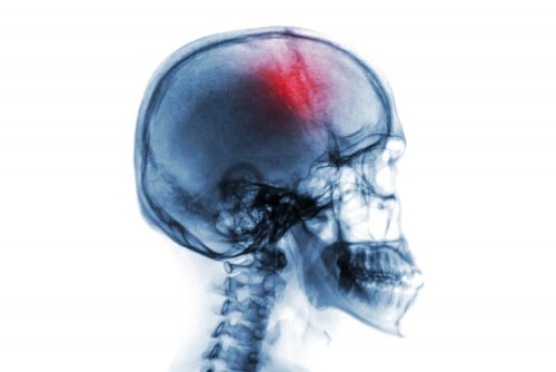 Le schéma d'un cerveau subissant une hémorragie dans le cas d'une apoplexie
