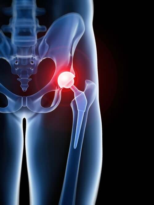 Une prothèse de hanche peut provoquer une bursite trochantérienne
