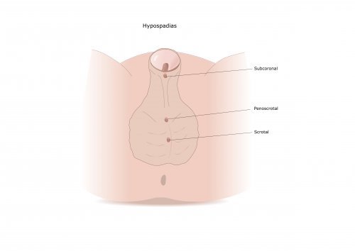 Hypospadias : symptômes et traitement