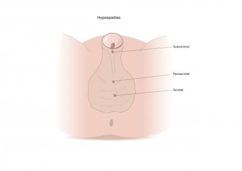 Hypospadias : symptômes et traitement