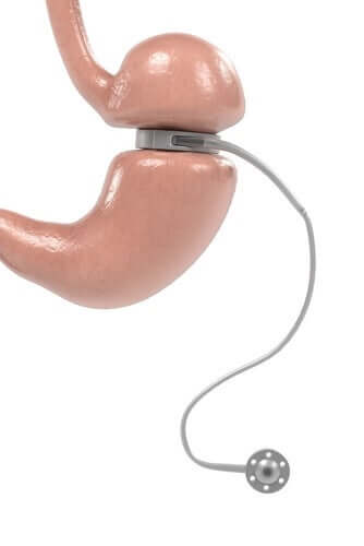 Une bande gastrique ajustable, qu'est-ce que c'est ?