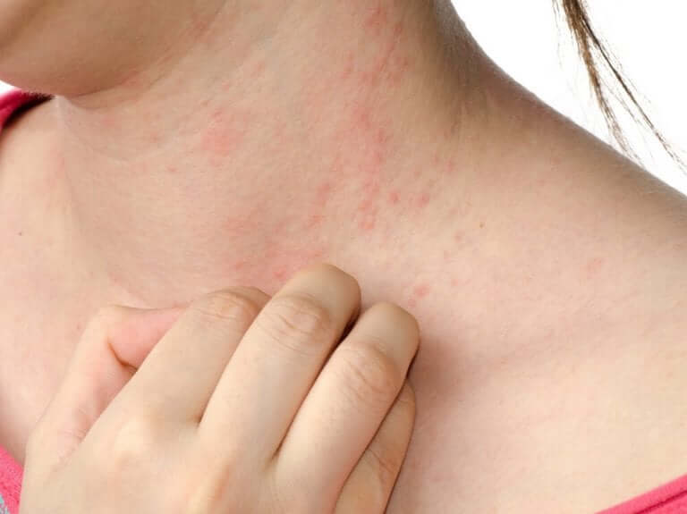 La dermatite atopique provoque des démangeaisons