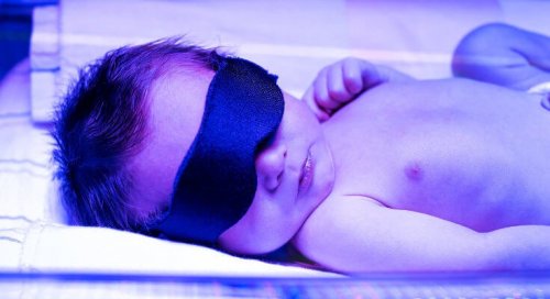 Un enfant souffrant d'un ictère lors d'une séance de photothérapie