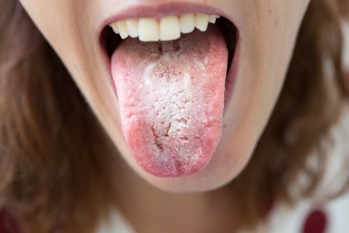 Une infection peut entraîner l'apparition de points noirs sur la langue