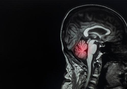 Métastases cérébrales : qu'est-ce que c'est et comment les traiter ?