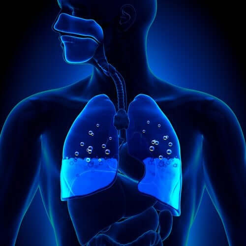L’œdème pulmonaire : symptômes et causes