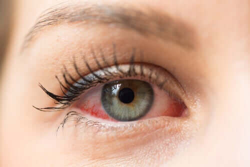 Un oeil rouge à cause de la kératite herpétique