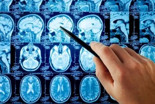 Une IRM du cerveau est nécessaire pour diagnostiquer les métastases cérébrales