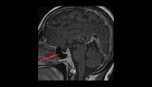 Une radiographie de la glande pituitaire