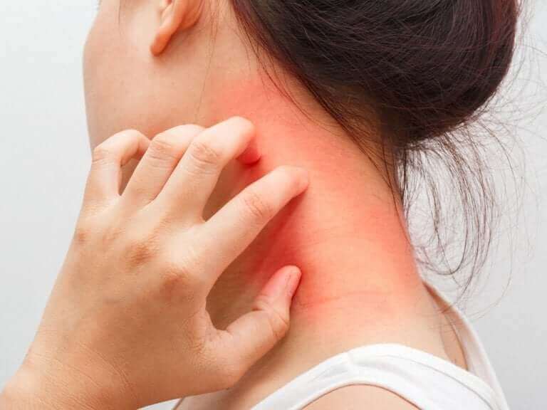 Une femme se grattant le cou à cause de la dermatite atopique