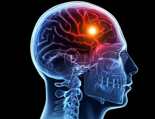 La représentation schématique de l'hypoxie cérébrale