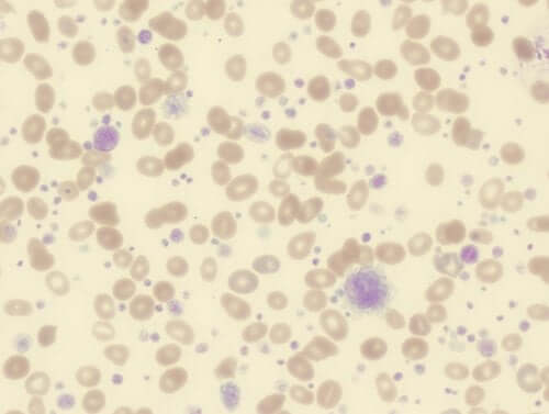 Thrombocytose : symptômes, causes et traitement