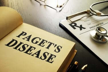 Qu'est-ce que la maladie de Paget ?