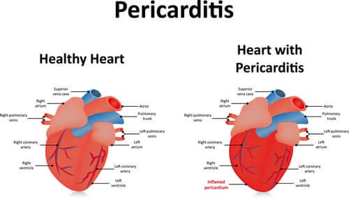 Un schéma d'un coeur souffrant de péricardite